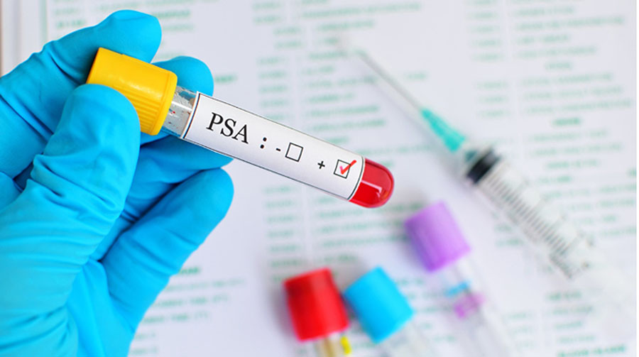 Риск развития биохимического рецидива и метастазов у пациентов с раком предстательной железы после радикальной простатэктоми