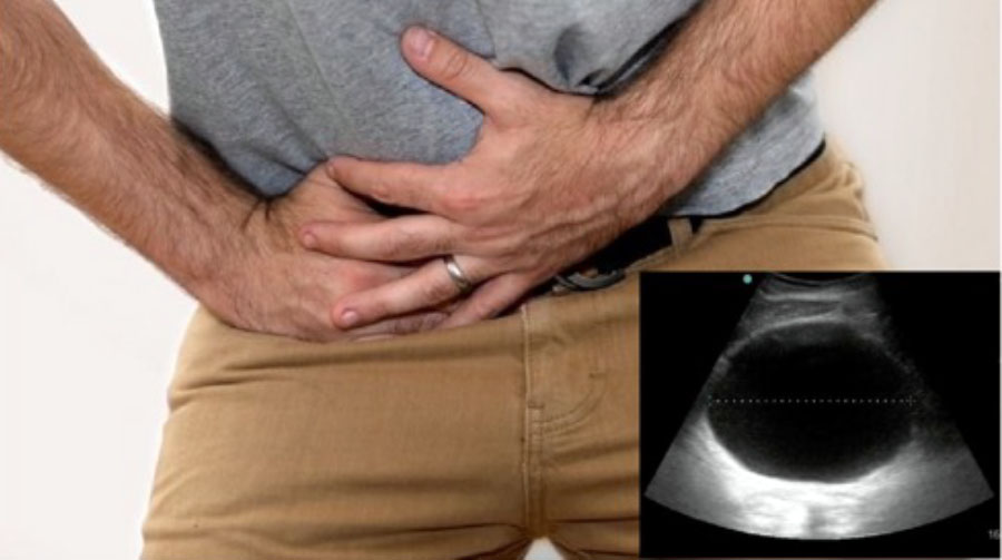 Острая задержка мочи после лазерной энуклеации гиперплазии простаты: кто в группе риска?