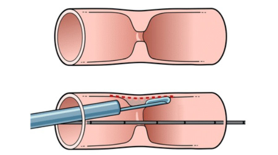 Дилатация уретры перед лазерной энуклеацией аденомы простаты
