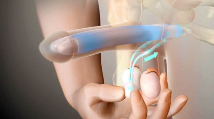 Одномоментная радикальная простатэктомия при раке простаты и установка пенильного протеза