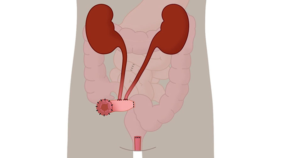 Стентировать или не стентировать после радикальной цистэктомии: есть ли разница в ранних послеоперационных результатах?