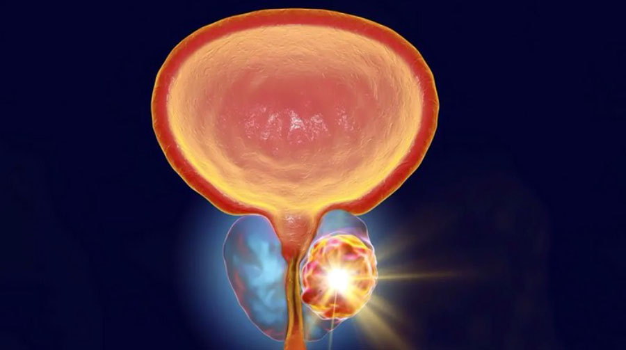 Рак простаты после лазерной энуклеации аденомы: кто в группе риска и что делать?