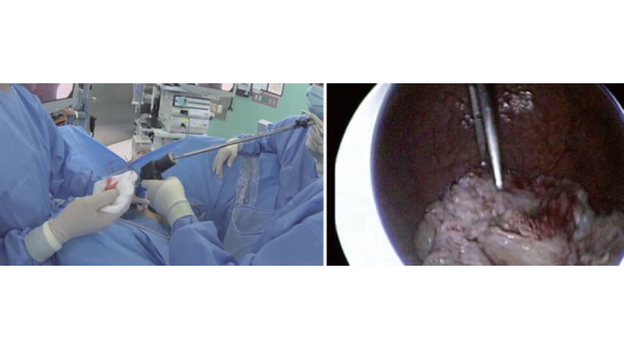 Новый метод удаления аденоматозной ткани после лазерной энуклеации (HoLEP)