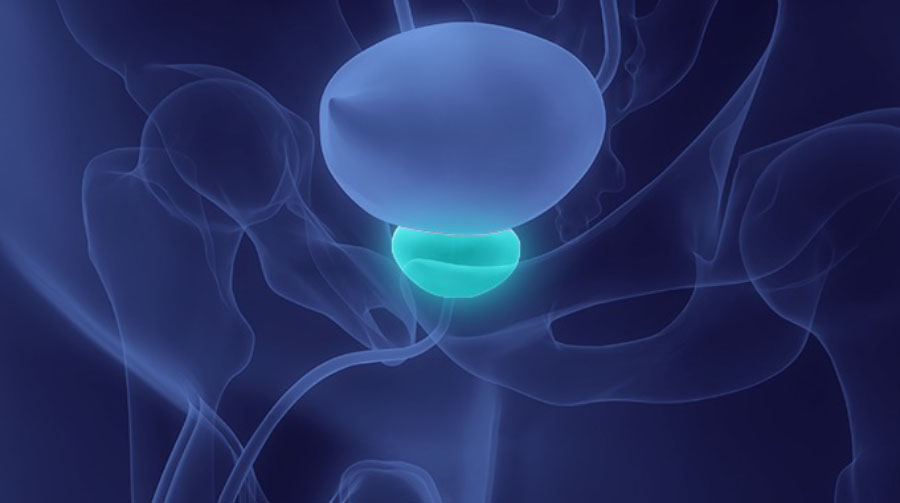 Лазерное удаление аденомы или ее эмболизация: выбор очевиден ?