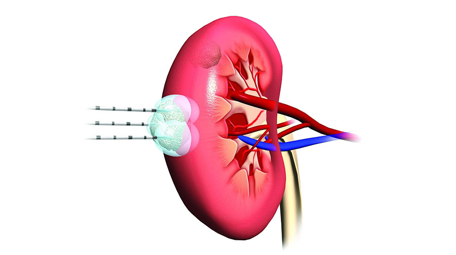 РАК ПОЧКИ: МОЖНО ЛИ ИЗБЕЖАТЬ БОЛЬШОЙ ОПЕРАЦИИ?