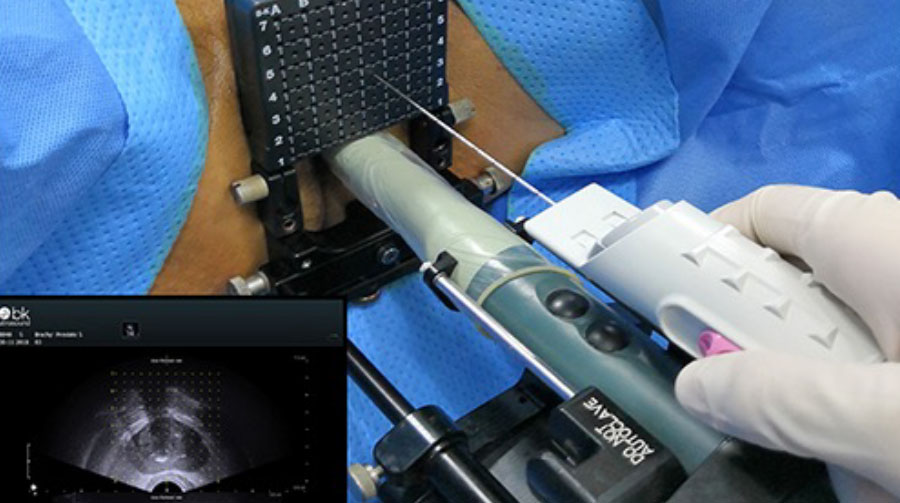 Трансперинеальная или трансректальная биопсия: выбор очевиден?