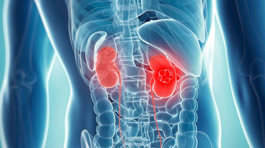 Метастатический рак почки - когда удалять орган и выполнять ли иммунотерапию?