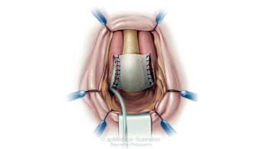 Оригинальное решение двух мужских проблем сразу