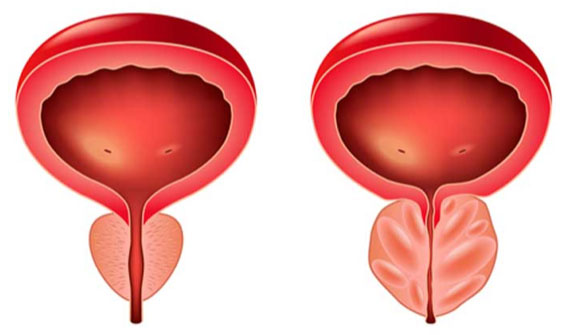 prostatit.jpg prostatit.jpg