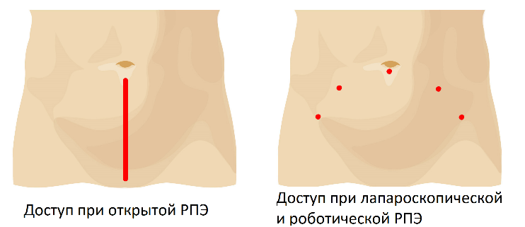 radikalnaya-prostatektomiya.png