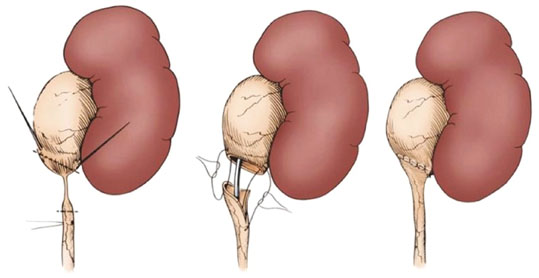 pieloplastika.jpg