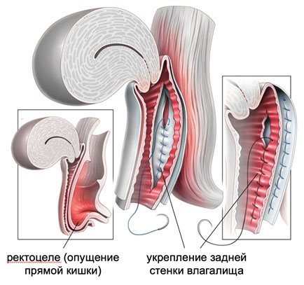kolpografiya.jpg
