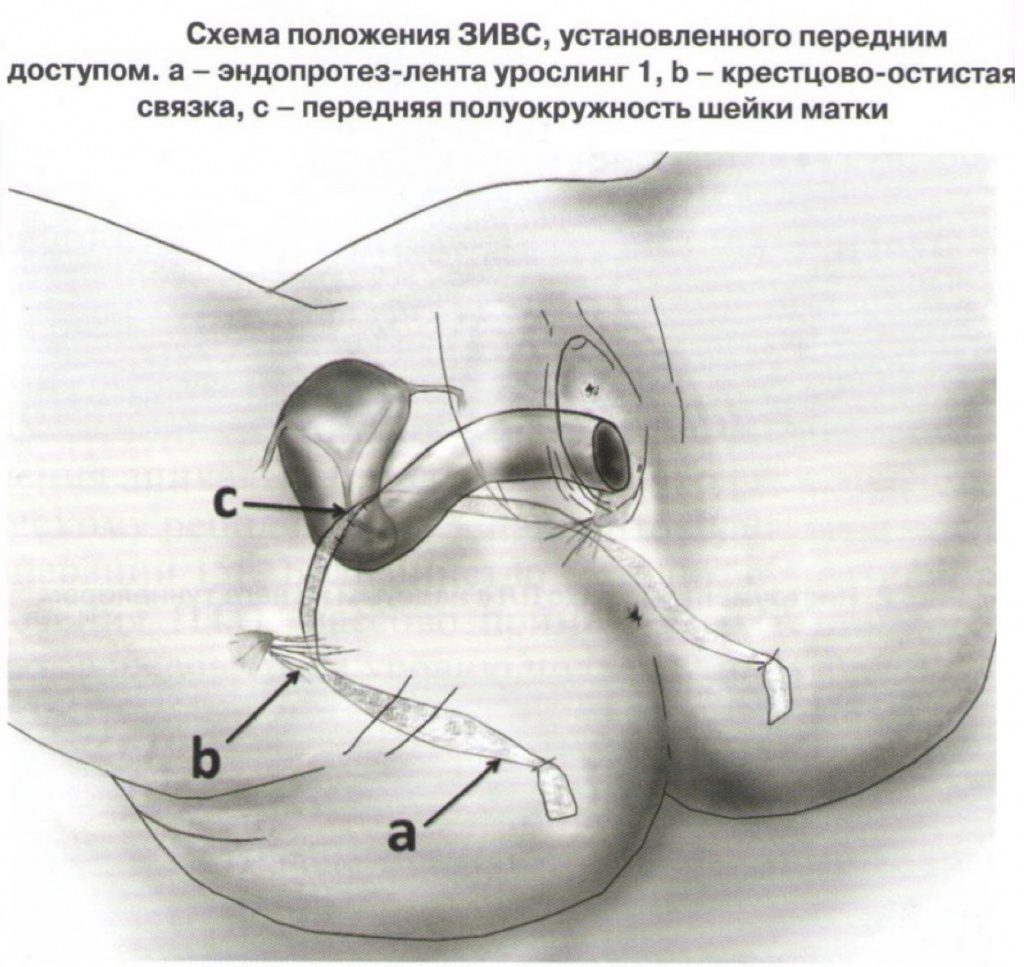 zadniy-sling.jpg