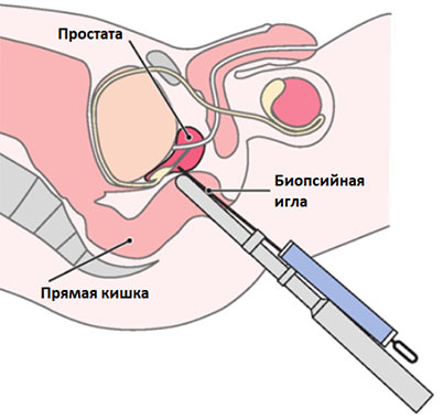 biopsiya-prostaty1.jpg