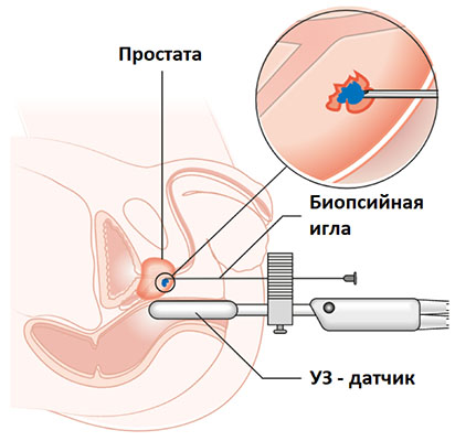 biopsiya-prostaty2.jpg