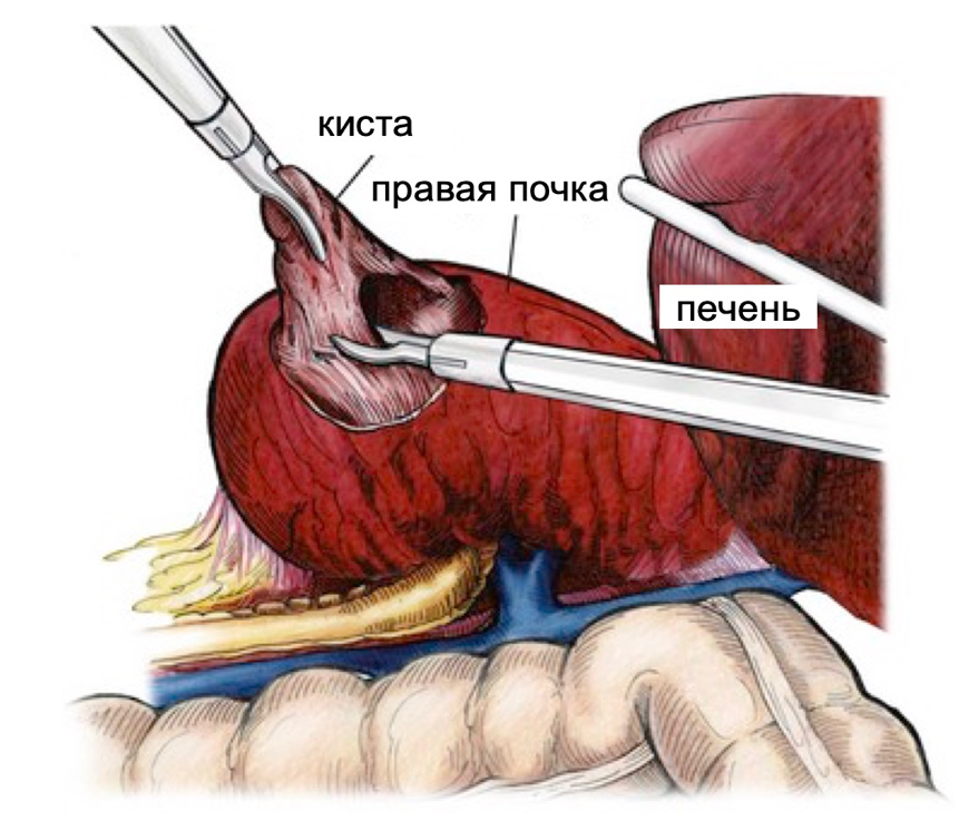 issechenie-kist.png